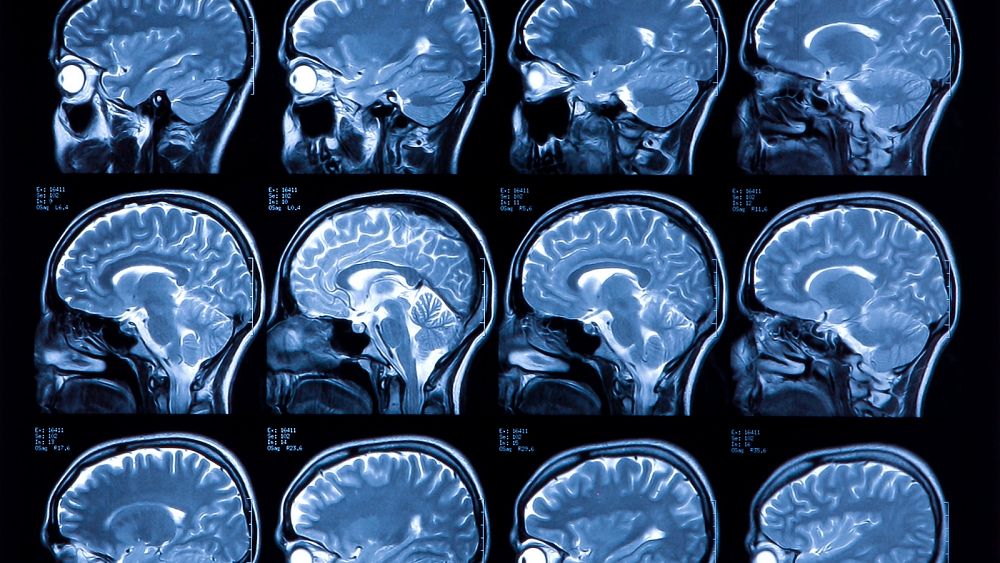 Potentially Life saving Study Could Cut Labelling Times For MRI Scans 