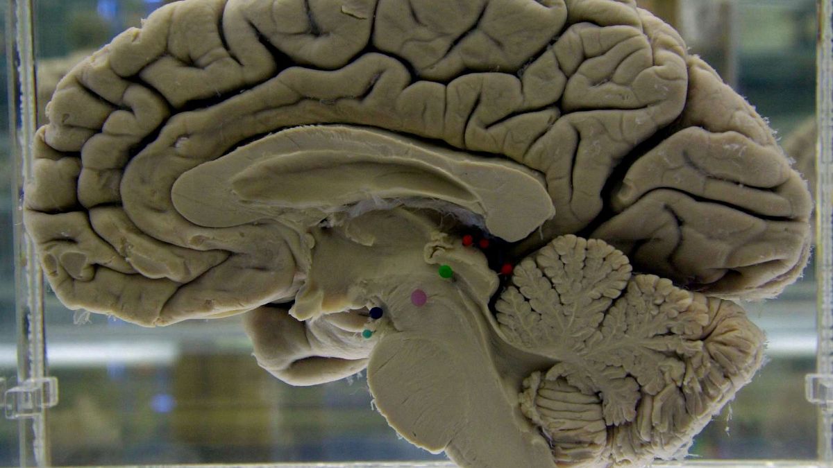 قسم من دماغ بشري معروض في متحف التشريح العصبي في جامعة بوفالو، نيويورك، الثلاثاء 7 أكتوبر 2003 