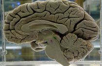 قسم من دماغ بشري معروض في متحف التشريح العصبي في جامعة بوفالو، نيويورك، الثلاثاء 7 أكتوبر 2003 