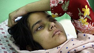 An Afghan girl receives medical care at the International Committee of the Red Cross (ICRC) physical rehabilitation center after being injured in fighting between the Taliban 