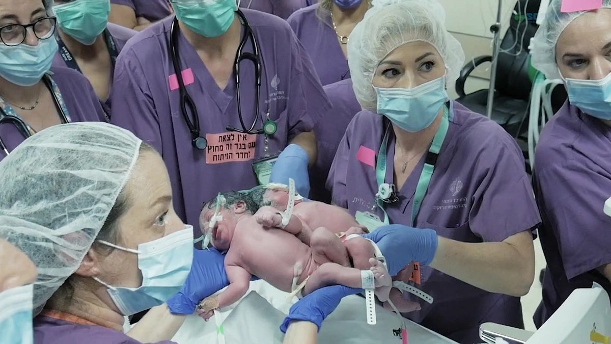 أطباء إسرائيليون ينجحون في فصل توأمين يبلغان من العمر عامًا واحدًا ملتصقين عند الرأس في مركز بئر السبع سوروكا الطبي.