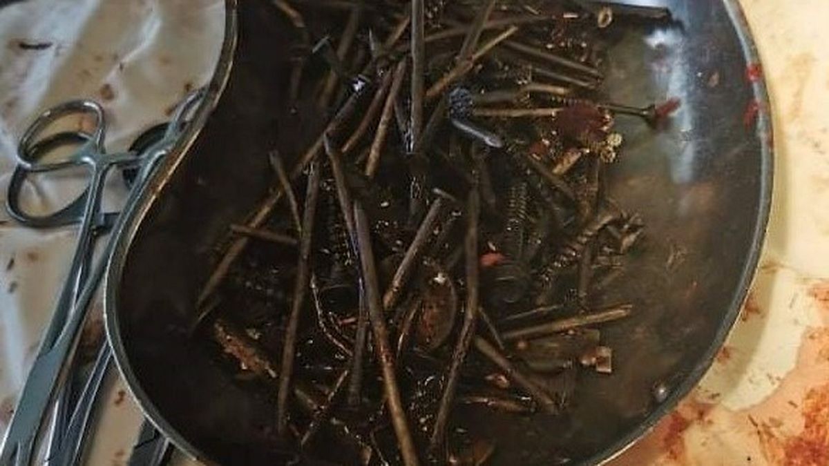 The assortment of metal objects removed from the man's stomach