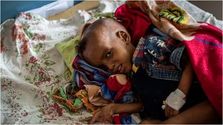 الطفل جبري كيدان جبريهيوت (عامان) أثناء علاجه من سوء التغذية في مستشفى أيدر في ميكيلي، في منطقة تيغراي بشمال إثيوبيا 6 أيار/مايو 2021