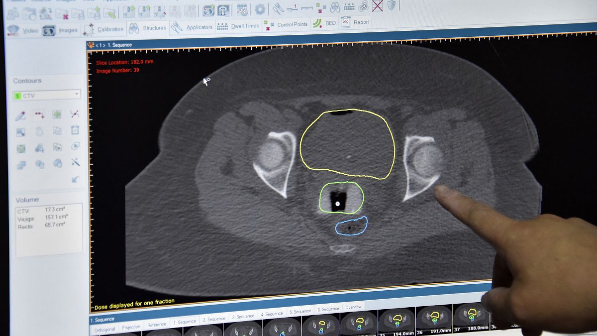 Ekranda rahim ağzı kanserini işaret eden bir doktor (arşiv)