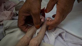 پاهای یک دختر ۴ ساله افغان که از گرسنگی رنج می برد 