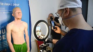 Congo: Brazzaville clinic helps embattled albino minority