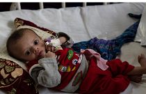 یک کودک دچار سوءتغذیه در بیمارستان آتاتورک کابل