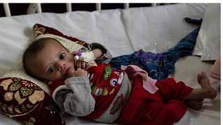 یک کودک دچار سوءتغذیه در بیمارستان آتاتورک کابل