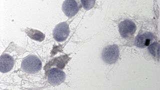 Covid-19 sperm kalitesini etkiliyor