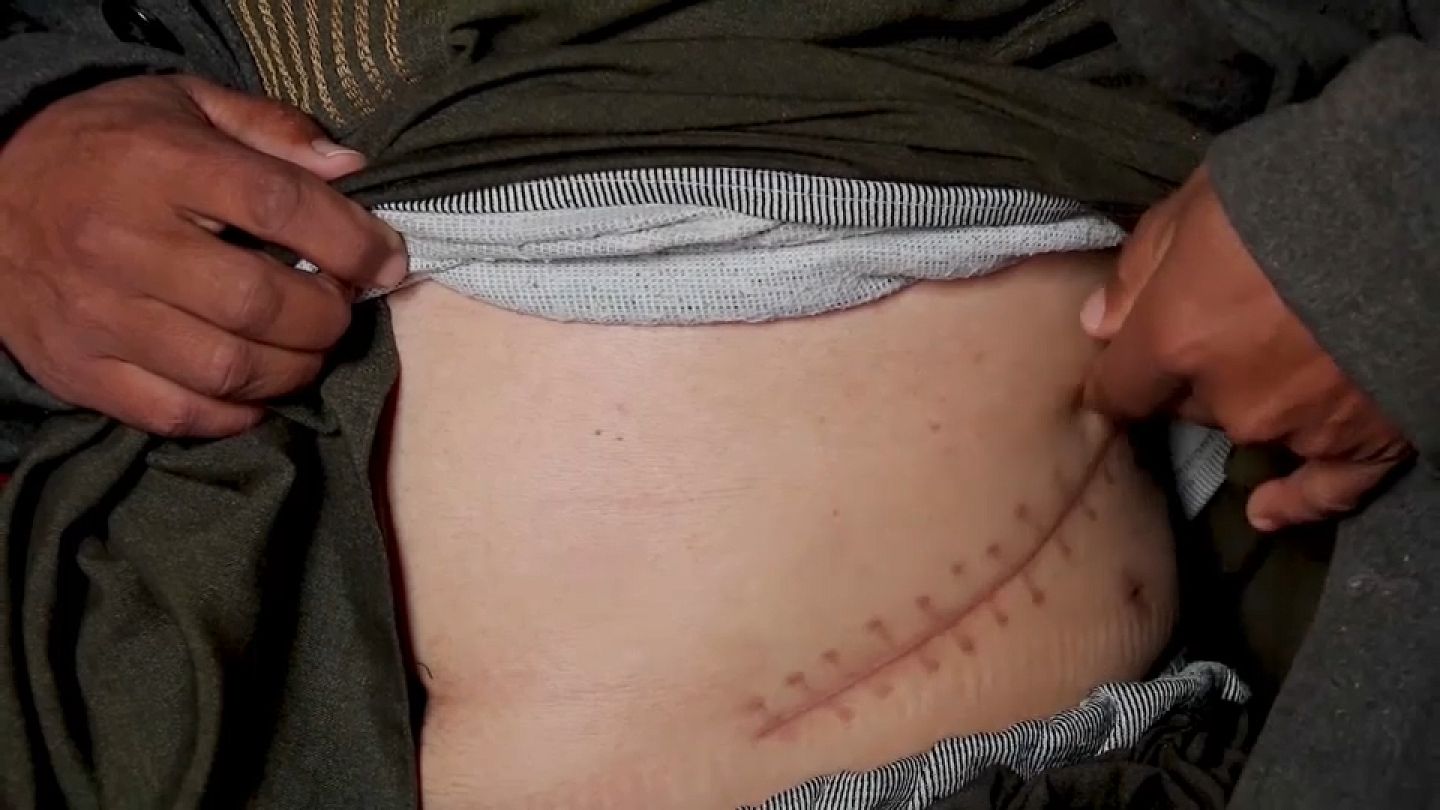 Cicatriz de extracción de riñón
Fuente: Euronews