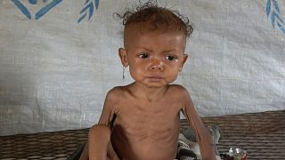الموت جوعا يهدد الطفلة رندا وملايين اليمنيين بسبب نقص المساعدات