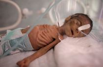 طفل حديث الولادة يعاني من سوء التغذية في حاضنة بمستشفى السبعين في صنعاء-اليمن (2019)