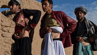 أفغان باعوا كليتهم على مدى السنوات الأربع الماضية يظهرون ندوبهم من العملية في قرية بازار سيشانبه في منطقة إنجيل بمقاطعة هرات. 2022/02/04