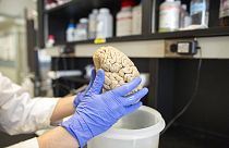 دراسات علمية حديثة تؤكد تبعات كوفيد على الدماغ
