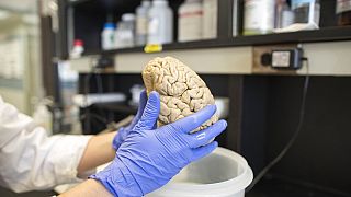 دراسات علمية حديثة تؤكد تبعات كوفيد على الدماغ