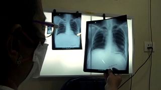 La lucha contra la COVID perjudica a la batalla contra la tuberculosis en la India