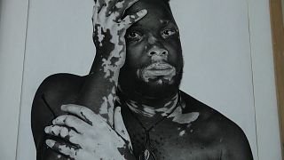 Artist uses paintings to highlight prejudice towards vitiligo