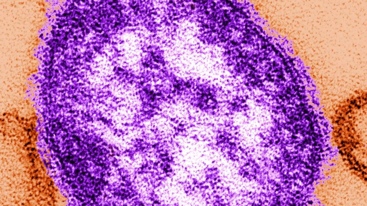 ویروس سرخک یکی از عوامل مرگ کودکان در جهان