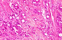 سلول‌های سرطانی پروستات