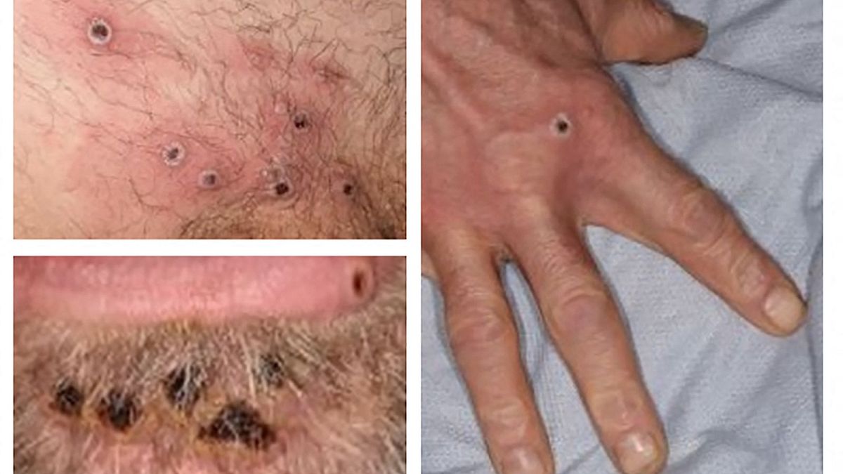 This figure demonstrates newly developing monkeypox lesions along the