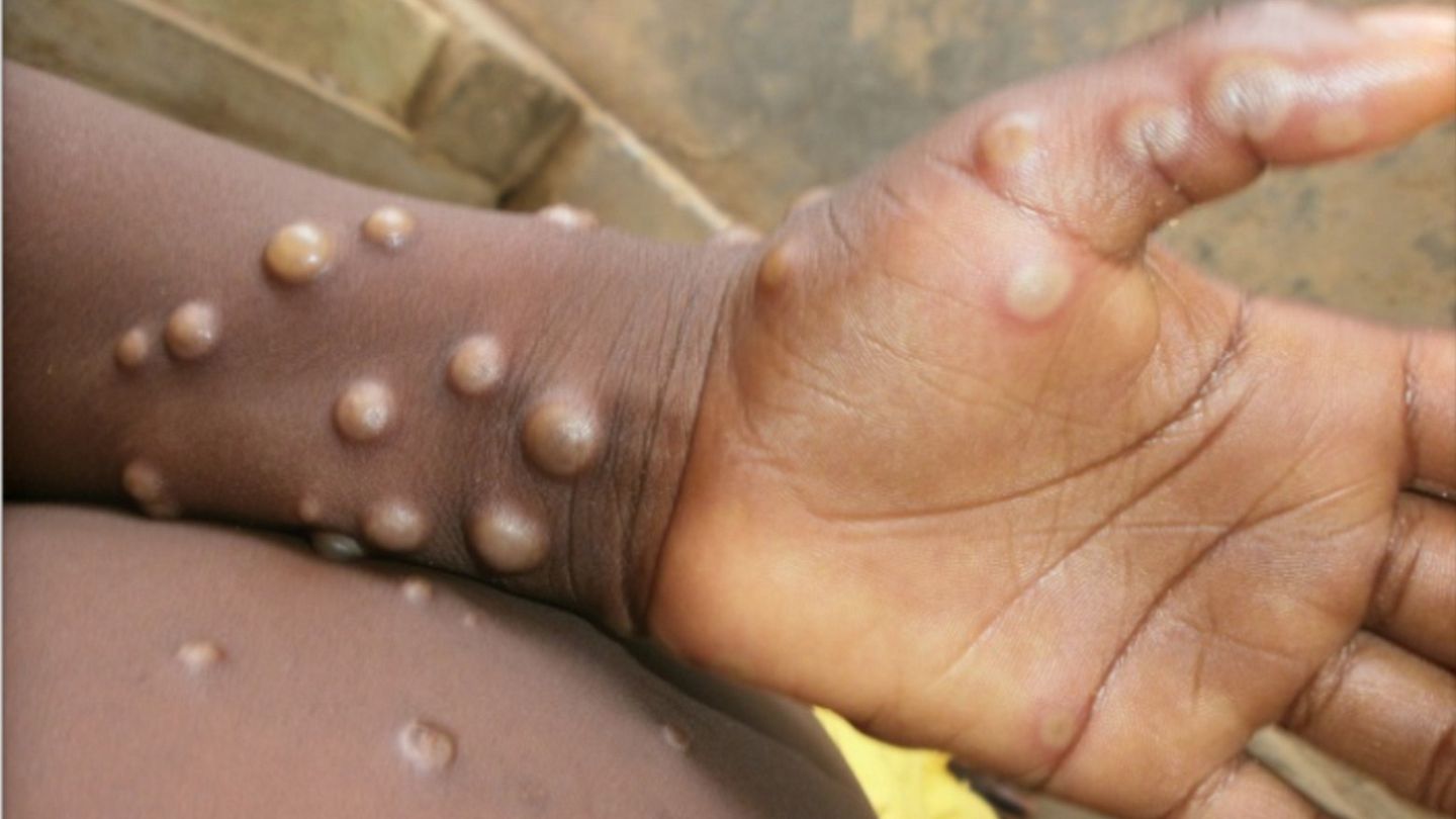 Monkeypox virus outbreak