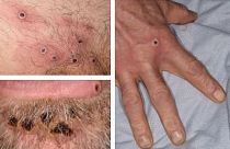 A handout from the UK Health Security Agency (UKHSA) shows a collage of monkeypox rash lesions at an undisclosed date.