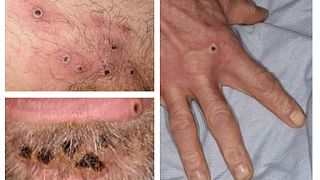 A handout from the UK Health Security Agency (UKHSA) shows a collage of monkeypox rash lesions at an undisclosed date.