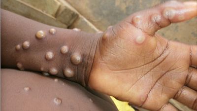 This rare smallpox-related virus causes flu-like symptoms and a nasty rash, and it can be deadly.