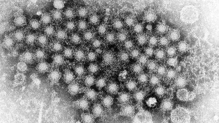 A group of hepatitis virions in an electron microscope image