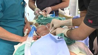 أطباء سعوديون ينجحون في فصل توأم ملتصق من اليمن