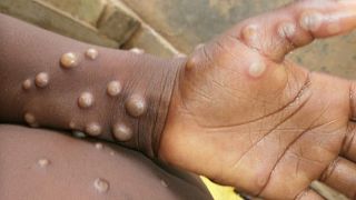 يسبب هذا الفيروس النادر المرتبط بالجدري أعراضًا تشبه أعراض الأنفلونزا وطفحًا جلديًا سيئًا ويمكن أن يكون مميتًا.