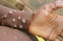 Ce rare virus lié à la variole provoque des symptômes pseudo-grippaux et une éruption cutanée désagréable, et il peut être mortel.