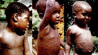 Crianças com varíola-dos-macacos, fotografadas na atual República Democrática do Congo em 1970