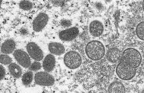 This 2003 electron microscope image shows mature, oval-shaped monkeypox virions, left, and spherical immature virions, right,