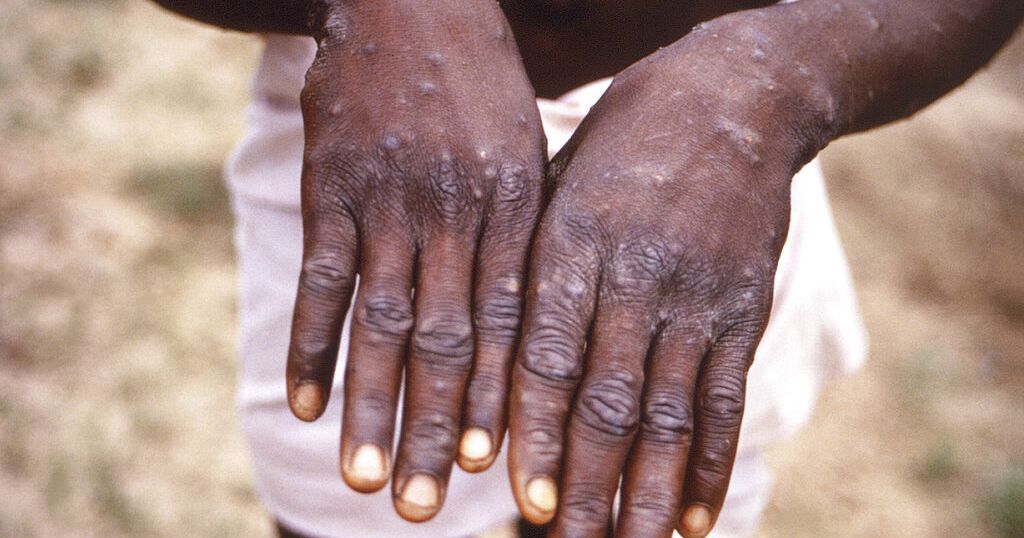 African scientists surprised by spread of monkeypox cases | Africanews