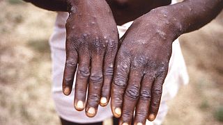Majomhimlővel fertőzött betegk Afrikában - KÉPÜNK ILLUSZTRÁCIÓ