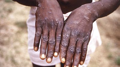 21 monkeypox cases confirmed in Nigeria – CDC