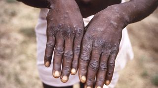 صورة ليد شخص مصاب بجدري القرود، من مركز السيطرة على الأمراض والوقاية منها في جمهورية الكونغو الديمقراطية. 1997