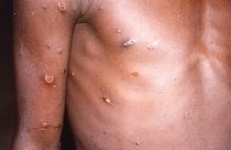 Scientists who have monitored numerous outbreaks in Africa say they are baffled by the recent spread of monkeypox in developed countries