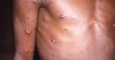 Monkeypox outbreak: Where has the smallpox-like virus spread so ...