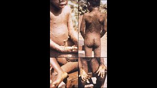La variole de singe, maladie rare d'Afrique inquiète 