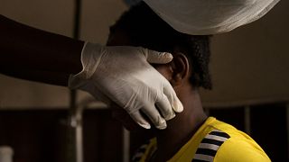 La variole de singe, maladie rare d'Afrique inquiète 