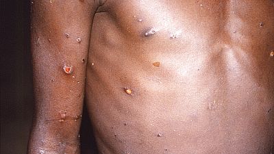  Three cases of monkeypox suspected in Morocco