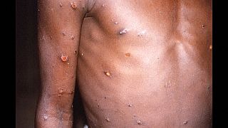 Síntomas de la enfermedad en la piel