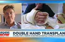 Double hand transplant