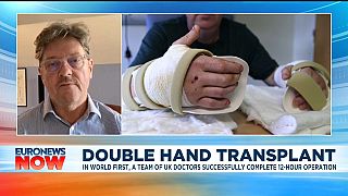 Double hand transplant