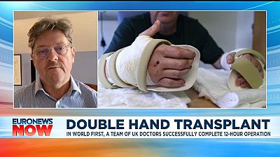 Double hand transplant