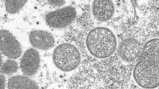 Le nombre de cas confirmés de variole du singe, un virus apparenté à la variole, est en hausse