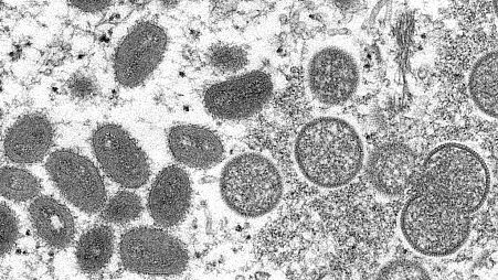 This 2003 electron microscope image made available by the Centers for Disease Control and Prevention shows mature, oval-shaped monkeypox virions.