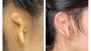 The patient's ear before the surgery, left, and 30 days after the surgery, right.